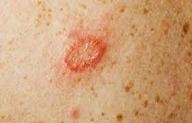 皮膚の真菌感染に効く15の自然療法 真菌 自然療法 スキンケア