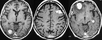 コロナきよつけや みせろー 開脚ー すご おい床そこ代われ 絶対コイツナルシストww 白パンだな 太ももの太さ推定45cm 床になったら直接、パンツをつけ. ä¸­æž¢ç¥žçµŒåŽŸç™ºãƒªãƒ³ãƒ'è…« Pcnsl è„³å¤–ç§'åŒ» æ¾¤æ'è±Šã®ãƒ›ãƒ¼ãƒ ãƒšãƒ¼ã‚¸