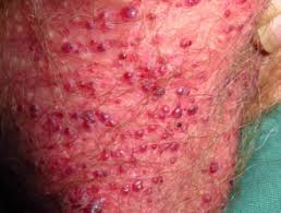 Fordyce spots are enlarged sebaceous glands. Angiokeratoma Dermnet Nz