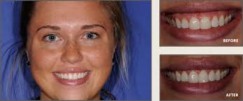 While some people do experience discomfort and swelling for the first few days after the procedure, the healing time is. Gummy Smile Treatment In Plano Tx Fix Gum Recession