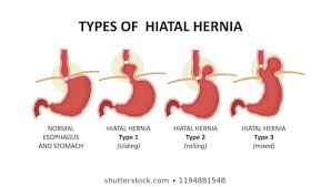 1000 hernia stock images photos vectors shutterstock