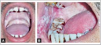 Ice massage with an ice stick applied to the throat, base of the anterior faucial arches, base of the tongue, and posterior pharyngeal wall is widely used in japan as a prefeeding technique to induce dry swallowing, to stimulate swallowing apraxia for initiating the swallow action, and in daily swallowing training. Jaypeedigital Ebook Reader