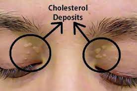 Kolesterol tinggi atau hiperkolesterolemia adalah suatu kondisi dimana kadar kolesterol total di dalam darah. Jika Temukan Tanda Ini Di Mata Bisa Jadi Kolesterol Ketinggian Semua Halaman Nakita