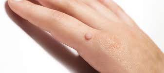 Image result for verruca