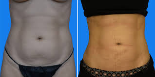 Image result for Liposuction