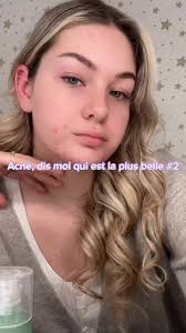 Révélez votre beauté naturelle avec ces conseils anti-acné!
