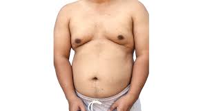Image result for Gynecomastia