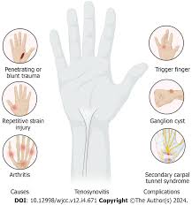 Image result for phlegmon of hand)