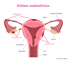 Endométriose solution naturelle
