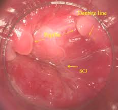 Image result for Anoscopy