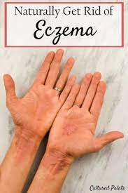 Eczema Affects People Differently And Can Look Different On Each Person One Common Factor Though Is The Itching Fi Get Rid Of Eczema Eczema Remedies Eczema