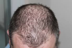 Out of all the natural oils, coconut oil might be the best oil for managing hair loss. Avoid Hair Loss In Men Naturally Soul Brasil Magazine