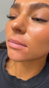 ✨ First-time lippie patient! ✨, This beauty wanted a soft, natural look —  and just ½ syringe of filler gave her the perfect enhancement. Balanced,  hydrated, and still so her. 💋, 📍 186 Aesthetics + ...