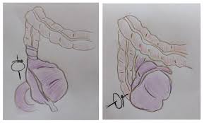 Pdf] Laparoscopic Management Of Mobile Cecum | Semantic Scholar