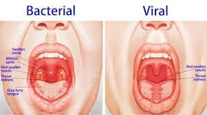 Cauzele care pot duce la apariția durerii în gât și în piept la înghițire pot fi determinate prin analizarea simptomelor specifice. Totul Despre Amigdalita Cauze Simptome Si Tratamente Infectie In Gat Tratament