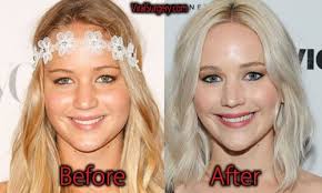 Pin On Plastic Surgery