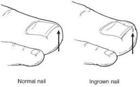 This involves cutting away the side edges of the nail and treating it with phenol to prevent the nail from growing back. Ingrown Toenail Hinsdale Foot Ankle Clinic