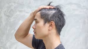 What type of hair loss treatment can i use? Losing Your Head Don T Hair Loss Is Managable