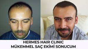 Yazarimiz Hermest Sac Ekim Merkezi Yorumlarini Ve Sonuclarini Anlatiyor