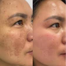 Stunning results with Restylane Eyelight! Brighten up those Tired Eyes 💤