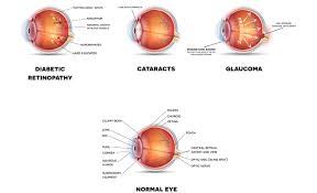 Diabetes mellitus can affect any system or organ in the body. 5 Ways Diabetes Can Affect Your Eyes Vision Medanta