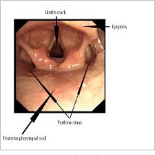 Image result for Intubation Associated Sinusitis