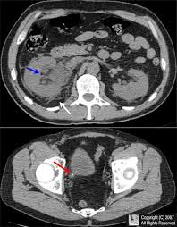 Urolithiasis Ureteral Calculus Obstructing Ureteral Calculus Non Enhanced Axial Ct Scan Images Of The Abdomen And Pelvis Demonst Radiography Ct Scan Radiology