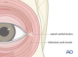 Image result for Lateral Canthotomy
