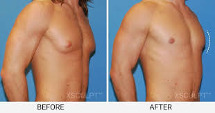 Image result for Gynecomastia