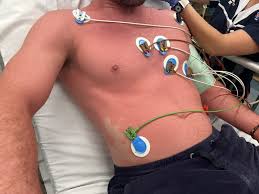 Image result for Scombroid Fish Poisoning