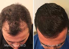 I'm technically trained in haircutting and styling from toni & guy hairdressing, specializing in all textures and types of. Hair Transplant Los Angeles Eyebrow Restoration Marc Dauer Md