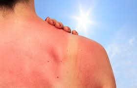 Sonnenbad 2 — sonnenbad, quelle, s.u. Sonnenbrand Verlauf Dauer Und Mogliche Spatfolgen Minimed At
