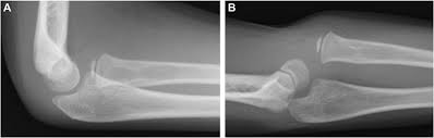 Image result for Elbow XRay
