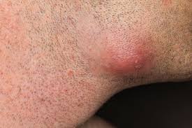 You develop a fever, such as 101°f (38°f) or higher. Boils Healthdirect