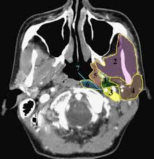 Neck Spaces 1 Parapharyngeal Space 2 Masticator Space 3 Carotid Space 4 Parotid Space 5 Mucosal Space 6 Perivertebral Space Anterior Portion 7 Retropha