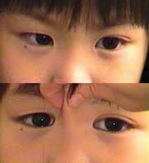 Epicanthic folds are common and found in greater than 60%.2. Pseudoesotropia Background Pathophysiology Epidemiology