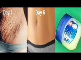 Topical treatment is far the most popular ways of treating stretch marks today. Remove Stretch Mark At Home In Few Days Using Vaseline Youtube Stretch Mark Remedies Stretch Mark Removal Cream Skin Tightening Treatments