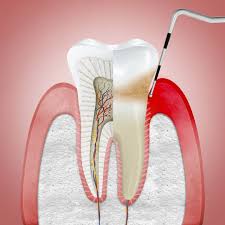 Image result for Gingivitis