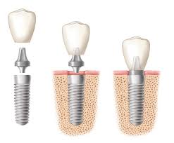 Maybe you would like to learn more about one of these? Dental Implants In Santa Barbara Weiser Grant Dentistry Dentist In Santa Barbara Ca Dr Mark T Weiser Dr Lance Grant