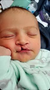 Cleft lip and cleft palate repairs are life changing operations., Alan  Estrada IV was born with a bilateral cleft lip and a type of cleft palate  where both the hard palate and soft palate are ...