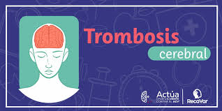 Palabras clave trombosis venosa cerebral; Por Que Ocurre Una Trombosis Cerebral