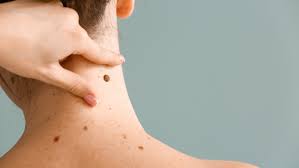Image result for Self Skin Exam