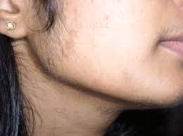 Excessive facial hair usually is associated with hair loss on your scalp and is associated with an excess of male hormones, says trichologist yvonne solomon. Facial Hair And Unwanted Hair With Homeopathy Approach Female Facial Hair Unwanted Facial Hair Unwanted Hair