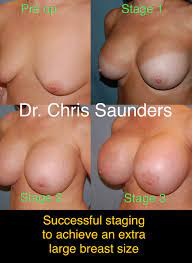 Choosing Extra Large Breast Implants Can Have Increased Risks - Dr. Chris  Saunders MD