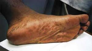 Image result for syphilis symptoms