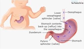 Image result for Pediatric Reflux