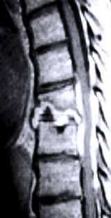 Image result for Spinal Infection