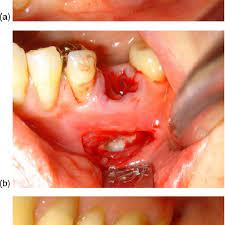 The abscess may have caused the tooth to become loose, and in this case, an extraction may be the. A Tooth Extraction B Extraction Socket With Vestibular Window Download Scientific Diagram