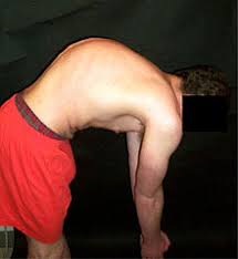 Scheuermann's kyphosis involves wedging of vertebrae (generally thoracic) which creates a kyphotic deformity >45 degrees. Scheuermann S Disease Wikipedia