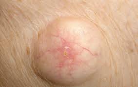 Ingrown pubic hairs can form cysts, lumps of fluid beneath the skin. False Std Symptoms After Sex